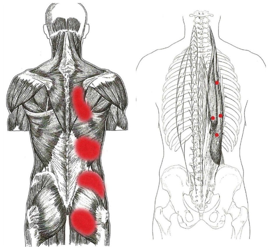 Триггерные точки на спине фото