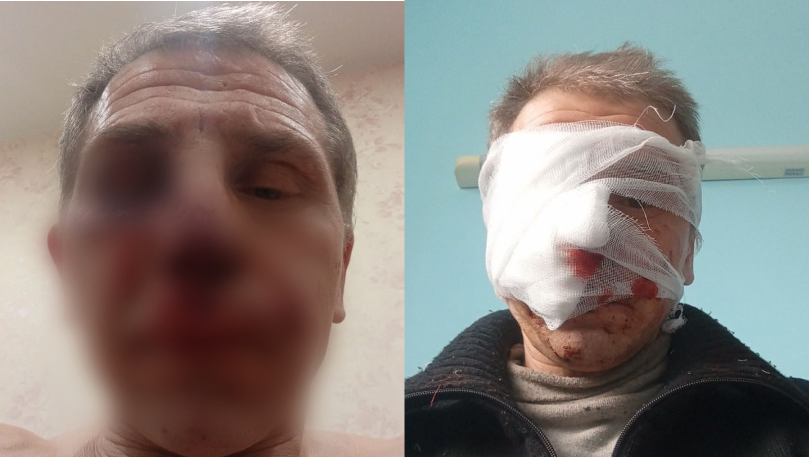 У мужчины множественные рваные раны лица и руки