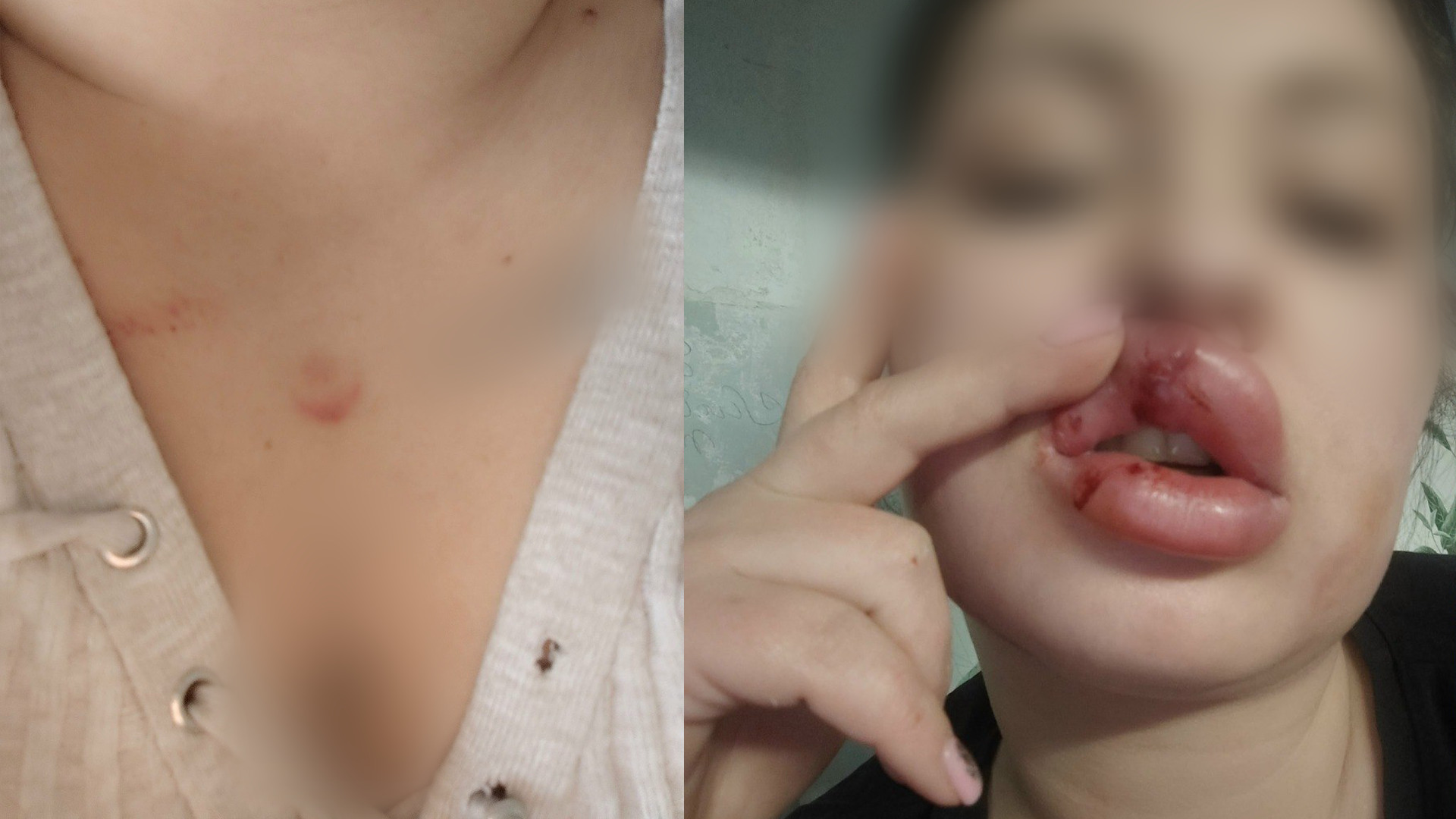 У девушки серьёзные травмы лица и отпечаток дула на груди 