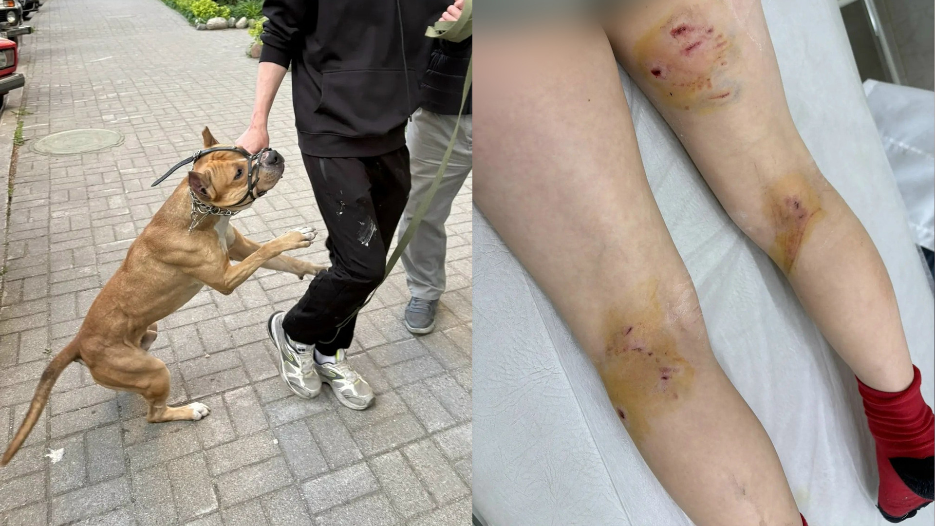 У Платона раны гораздо серьёзнее — намордник не помешал собаке нанести ребёнку такие травмы