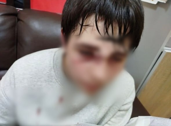 Во время драки мальчик получил перелом носа и руки